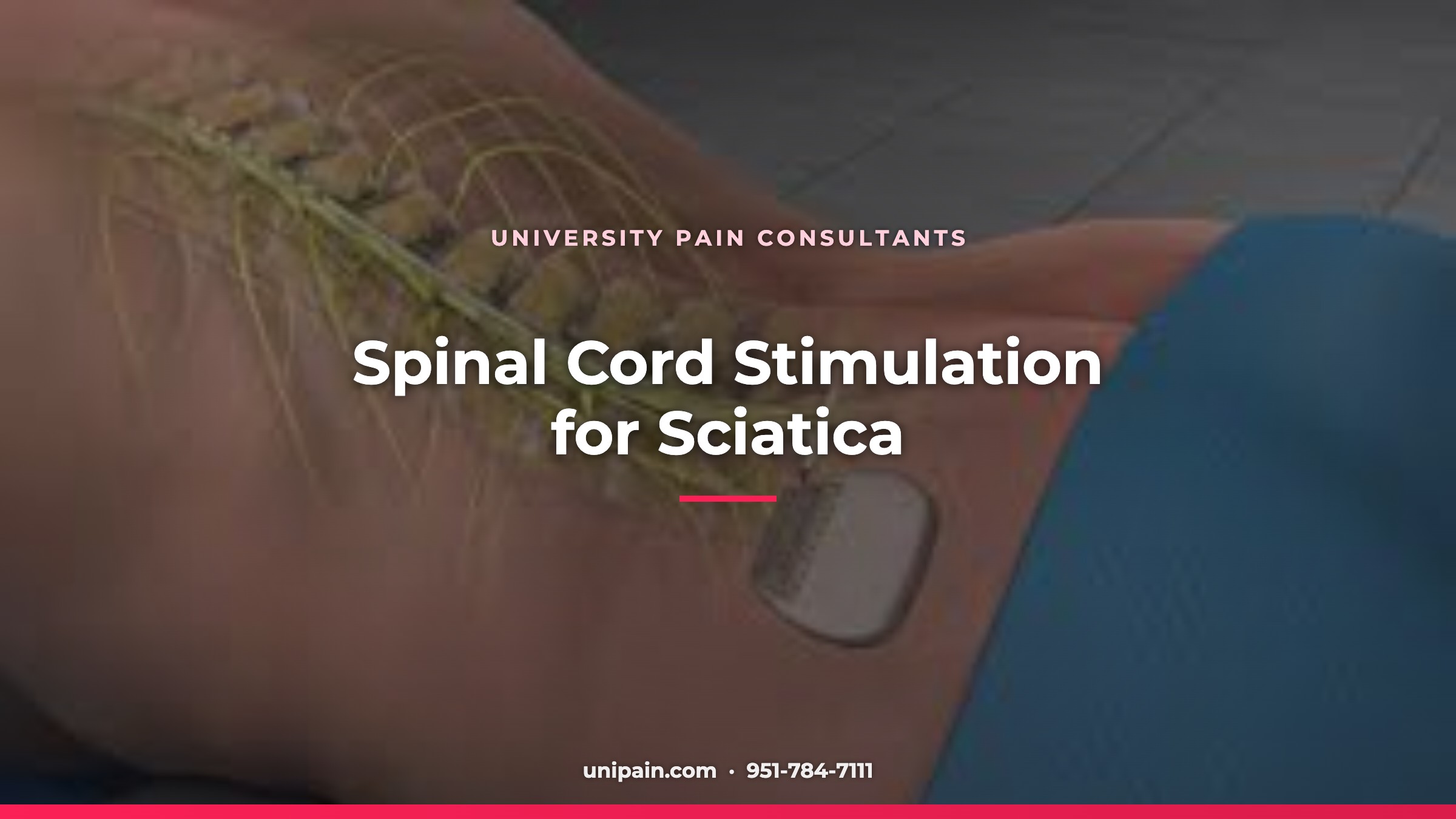Spinal Cord Stimulation for sciatica